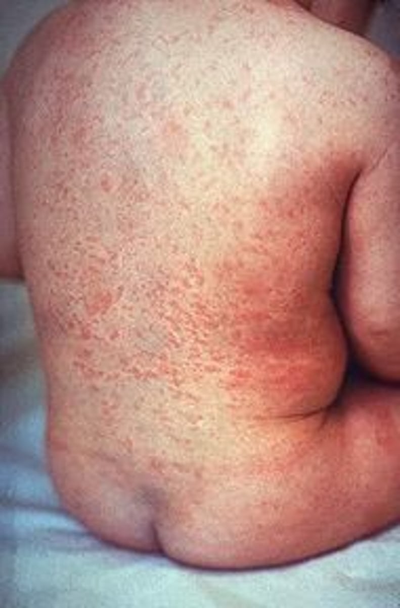 <p>- URI prodrome with low-grade fever, malaise, and lymphadenopathy (posterior auricular, occipital)</p><p>- Pink/light red nonconfluent maculopapular rash&nbsp;that&nbsp;starts on the face spreads to the trunk/extremities&nbsp;and&nbsp;LASTS 3 DAYS&nbsp;(compared to 7 for measles). It spreads more rapidly and does not coalesce or darken like measles</p><p>- Forchheimer spots: small red macules or petechiae on soft palate</p><p>- Photosensitivity and joint pains</p>