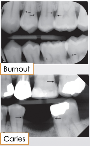 <ul><li><p><span style="color: #000000">Artifact that can mimic caries</span></p></li><li><p><span style="color: #000000">Commonly at or just apical to CEJ near alveolar crest</span></p></li><li><p><span style="color: #000000">X-rays passing tangentially through proximal area encounter less structure</span></p><ul><li><p><span style="color: #000000">Thinner tooth structure absorbs fewer x-rays → appears relatively more radiolucent</span></p></li></ul></li><li><p><span style="color: #000000">Shallow depression/concavity on mesial/distal root surface can make area appear more radiolucent</span></p></li><li><p><span style="color: #000000">Imperfect mesiodistal overlap of roots in multirooted teeth</span></p><ul><li><p><span style="color: #000000">Confirm by identifying PDL spaces of each roo</span></p></li></ul></li></ul><p></p>