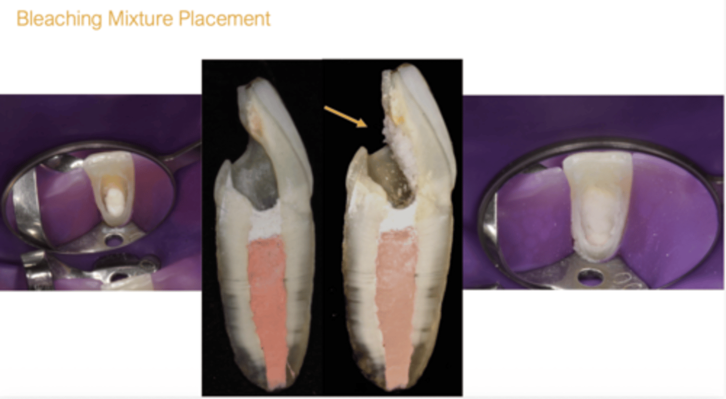 <p>Facial wall (not at incisal edge though)</p>
