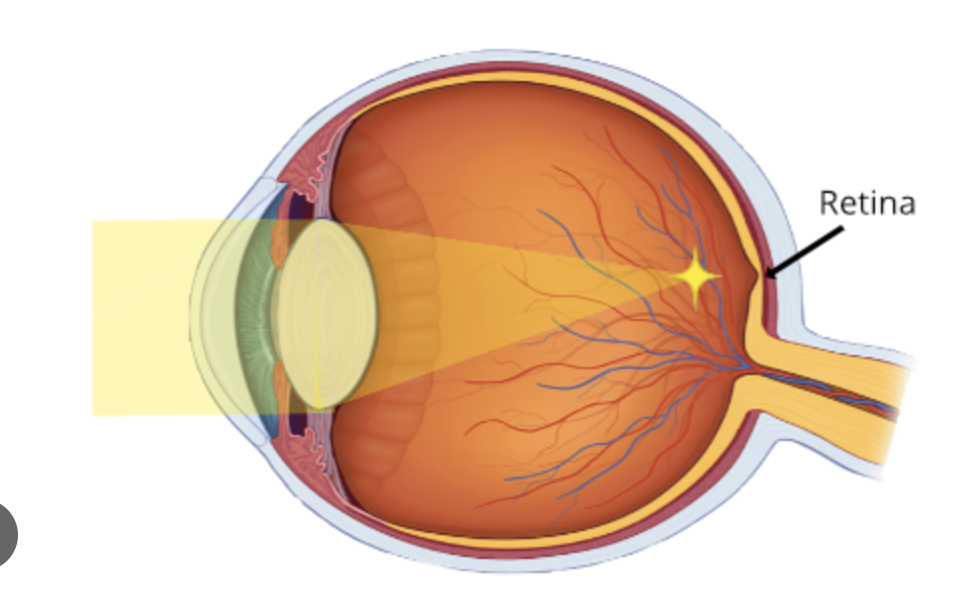 <p>short sightedness caused by an elongated eyeball. focused image falls before the retina</p>