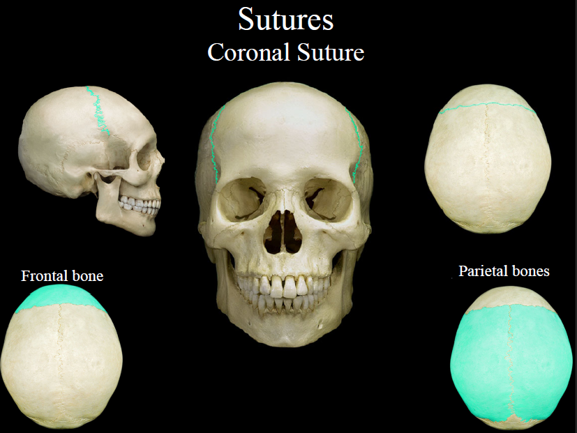 <p>the suture between the parietal and frontal bones of the skull</p>