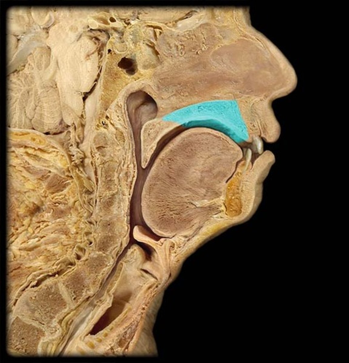 <p>formed by palatine processes of maxillae bones & horizontal plates of palatine bones</p>