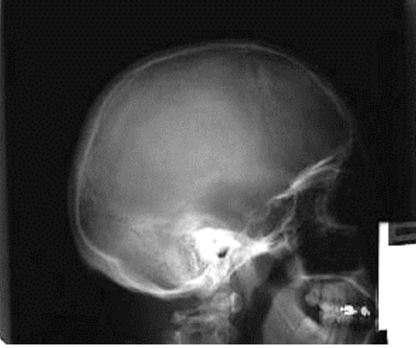 <p><strong>Which baseline is parallel to the longitudinal axis of the IR/FOV in the image below?</strong><br>A. Infraorbital meatal line<br>B. Orbitomeatal line<br>C. Glabellomeatal line<br>D. Interpupillary line</p>
