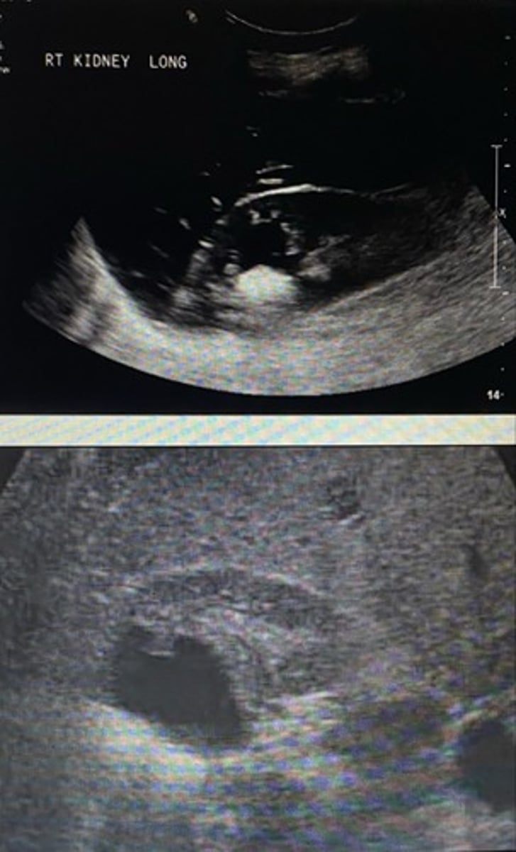 <p>Lesion, echogenic, dependent</p>