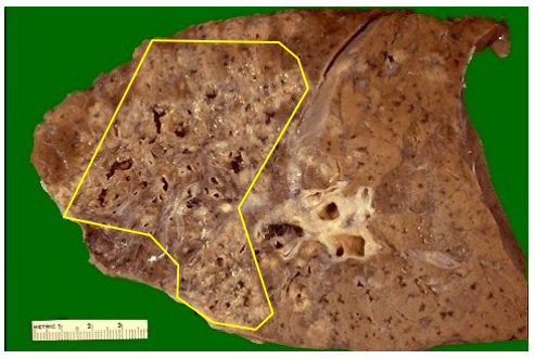 <ol><li><p>Feature of <span> a case of active pulmonary granuloma</span></p></li><li><p>Duration of granuloma development</p></li><li><p>Infectious cause of pulmonary granulomas</p></li><li><p><span>Granulomatous inflammation in this lung can lead to __ necrosis</span></p></li></ol><p></p>
