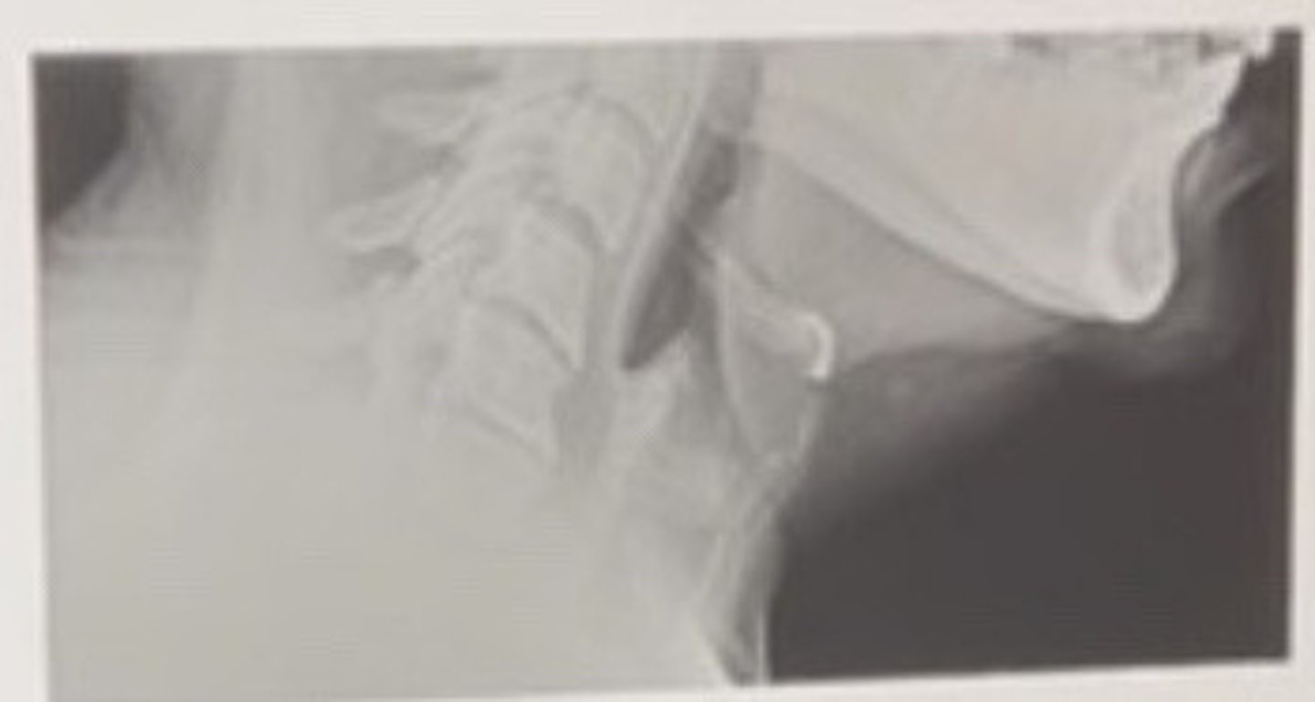 <p>The most Ikely diagnosis for the finding in the froetal sinus is</p>