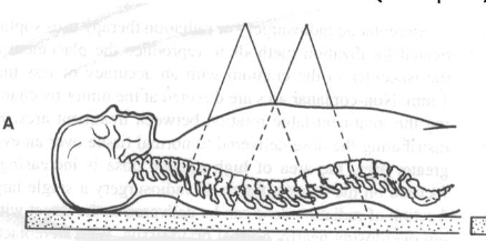 <p>Potential Spinal Cord Damage</p>