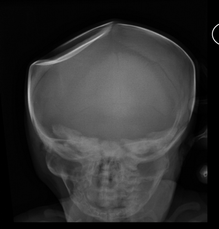 <p>What is a depression bone fracture?</p>