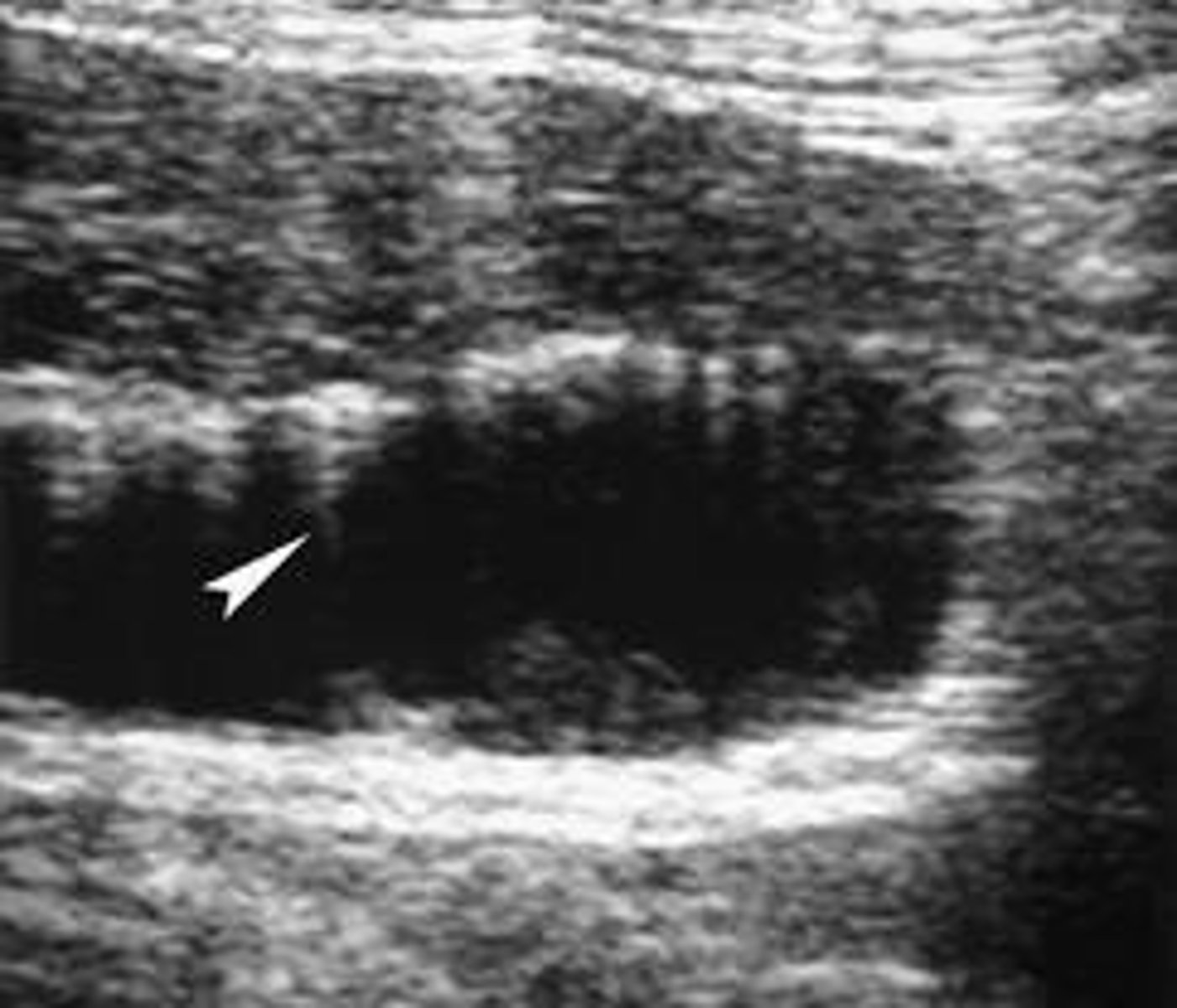 <p>-asymptomatic</p><p>-small, echogenic foci seen in GB wall with comet tail/reverberation artifact seen posterior</p><p>-no movement with change in patient position</p>