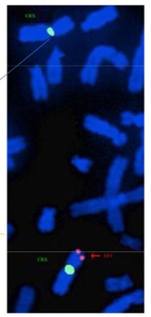 <p>→ fluorescent in-situ hybridisation</p><ul><li><p>detecting prescience/absence of specific DNA sequences</p></li><li><p>Utilities short fluorescents labelled DNA probes</p></li><li><p>Used in genetic counselling, cancer etc</p></li></ul><p>To identify chromosome translocations = where a segment from one chromosome is transferred to another</p><p></p>