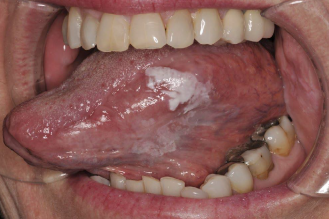 <p><span style="color: blue;"><strong><em><u>PRE-MALIGNANT NEOPLASMS</u></em></strong></span></p><p>Leukoplakia</p><ul><li><p>Clinical Signs</p></li><li><p>Location</p></li><li><p>Etiology</p></li><li><p>Treatment</p></li></ul><p></p>