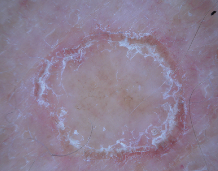 <p>The most distinguishable clinical presentation of secondary syphylis is <strong><mark data-color="#f56363" style="background-color: #f56363; color: inherit">erythematous PAPULES</mark></strong> folllowed by <strong><mark data-color="#e7f097" style="background-color: #e7f097; color: inherit">Biett’s collarette of scaling</mark></strong>: a <strong>thin, whitish desquamating ring</strong> that sorrounds the syphylis papules.</p><img src="https://knowt-user-attachments.s3.amazonaws.com/11803313-285e-4535-828c-dfda1aaf75f6.png" data-width="75%" data-align="center"><p></p>