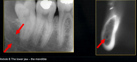 <p>inferior dental canal can easily be seen in cross sectional dental images </p>