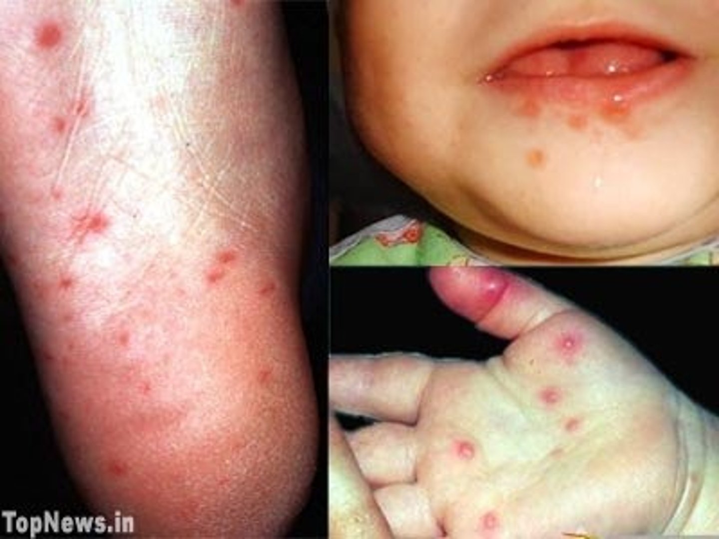 <p>dx: hand, foot, mouth disease (caused by coxsackie A)</p><p>tx: supportive (antipyretics, topical lidocaine)</p>
