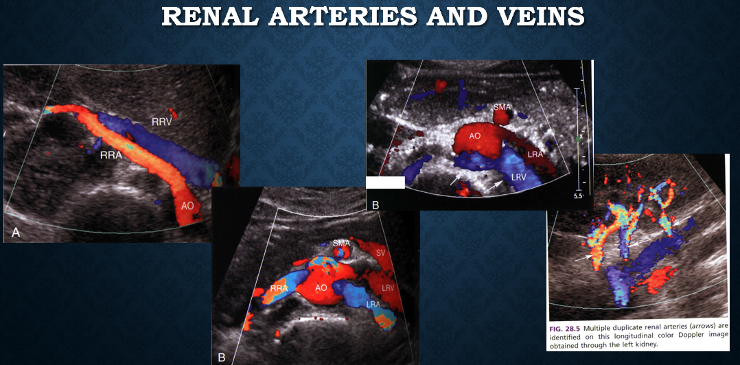 <p>renal vein thrombosis (partial or complete)</p>