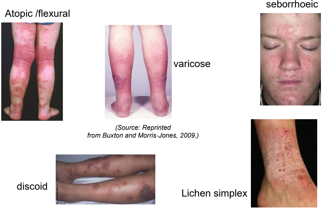 <ol><li><p>Atopic /flexural - young </p></li><li><p>varicose - old, venous incompetence </p></li><li><p>seborrhoeic - centre of face and the scalp , anogenital skin</p></li><li><p>discoid - coin shaped </p></li><li><p>Lichen simplex</p></li></ol><p></p>