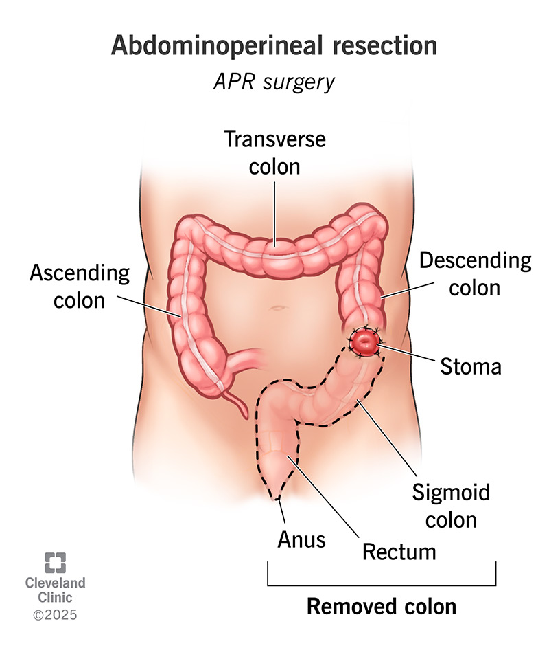 <ul><li><p>rectal cancer in lower 3rd of rectum&nbsp;</p></li><li><p>Removes anus so colostomy required&nbsp;</p></li></ul><p></p>