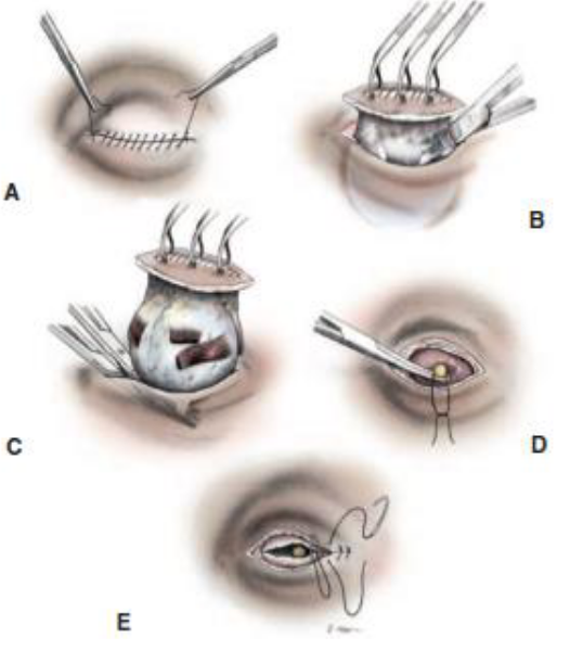 <p><strong><span style="color: blue">Evita a comunicação entre a superfície ocular e os conteúdos orbitáriosRemove todos os tecidos conjuntivais.</span></strong></p><p>Indicações:</p><ul><li><p><span style="color: green">Neoplasias intraoculares com invasão de parede;</span></p></li><li><p><span style="color: green">Panoftalmite;</span></p></li><li><p><span style="color: green">Neoplasias orbitárias.</span></p></li></ul><hr><p><span style="color: blue">Técnica:</span></p><ul><li><p><span style="color: purple">Pálpebras suturadas em padrão contínuo;</span></p></li><li><p><span style="color: purple">Incisão periocular a 3-5mm das margens palpebrais;</span></p></li><li><p><span style="color: purple">Dissecção por fora dos músculos extraoculares;</span></p></li><li><p><span style="color: purple">Nervo óptico e vasos são pinçados, seccionados eligdos com Nylon4,0;</span></p></li><li><p><span style="color: purple">Sutura da conjuntiva em ponto contínuo nylon 4.0;</span></p></li><li><p><span style="color: purple">Aproximação do subcutâneo e por fim sutura dapele com Ny 4.0 em pontos separados;</span></p></li><li><p><span style="color: purple">Remoção dos pontos 10-15 dias.</span></p></li></ul>