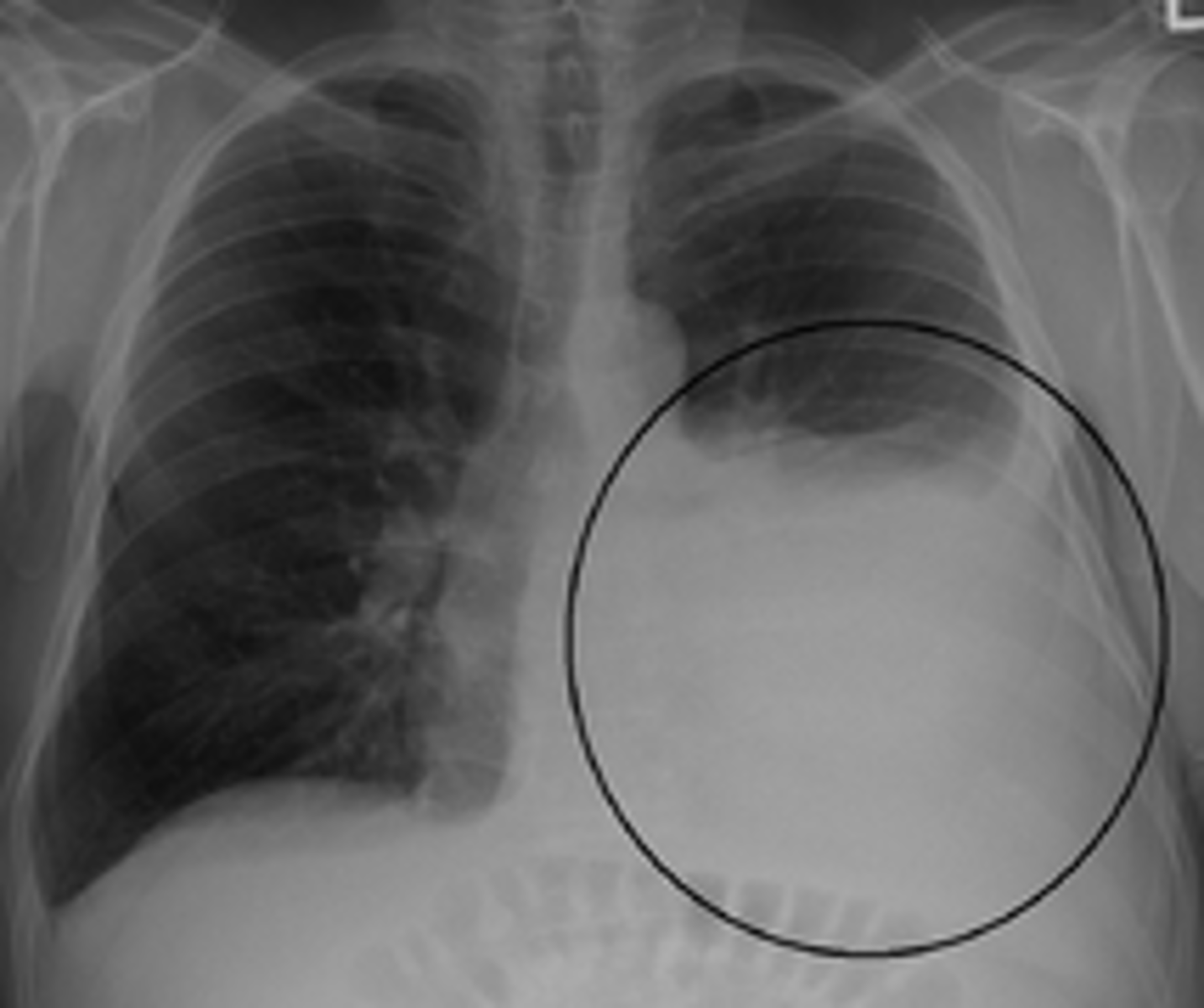<p>presence of chyle in the pleura, caused by disruption or dysfunction in the flow of chyle through the thoracic duct</p>