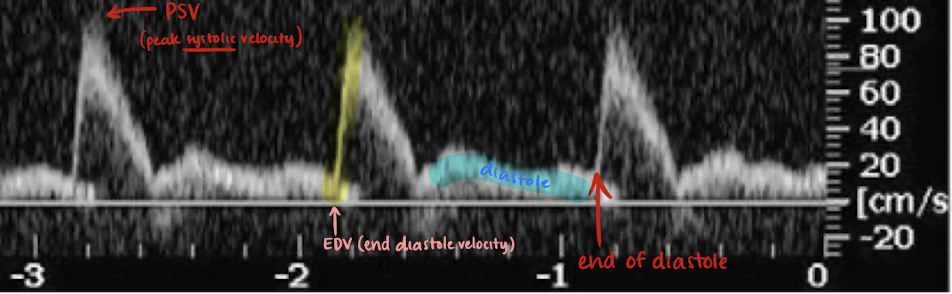 <p><u>high and low resistant</u> waveform; sharp brisk upstroke; significant reduced diastolic flow; no spectral broadening</p>