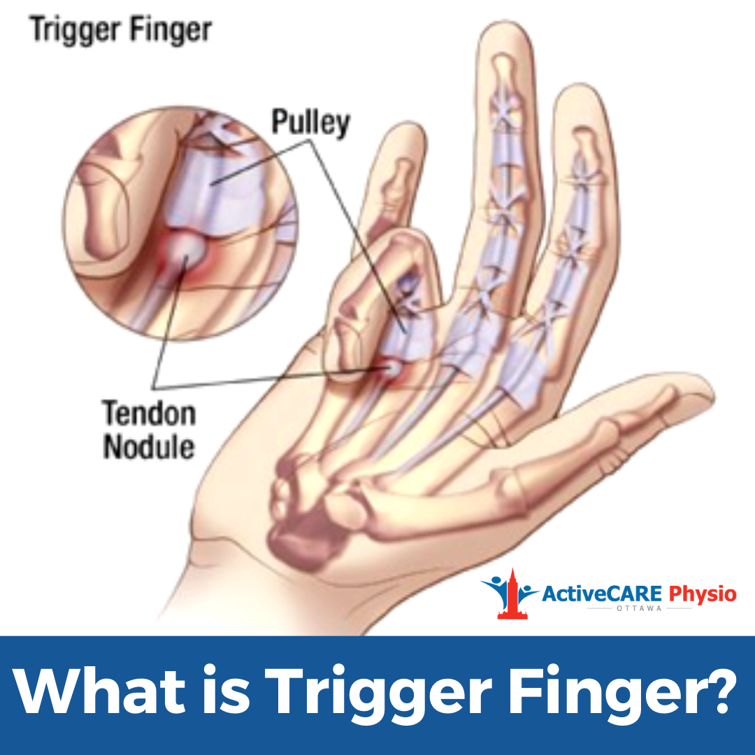 <p>-Tenosynovitis of the finger flexors (A1 pulley)<br><br>Conservative tx </p><ul><li><p>trigger finger MCP ext splint, IP joints free</p><ul><li><p>To rest the tendon/prevent snapping put on splint then gently bend &amp; straighten PIP joints 20x every 2 hours</p></li></ul></li></ul><ul><li><p>scar management</p></li><li><p>tendon glides</p></li><li><p>Edema control</p><p>-tendon glide consists of locked (fist), hooked fist, then extended added fingers</p></li></ul><p></p>