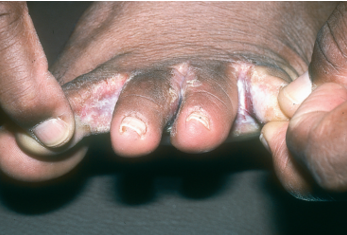 <ul><li><p><strong>Fungal Infection</strong>:</p><ul><li><p>Affects the feet</p></li><li><p>“Athlete’s Foot”</p></li><li><p>Red, scaling on the soles and between the toes</p></li></ul></li></ul><p></p>