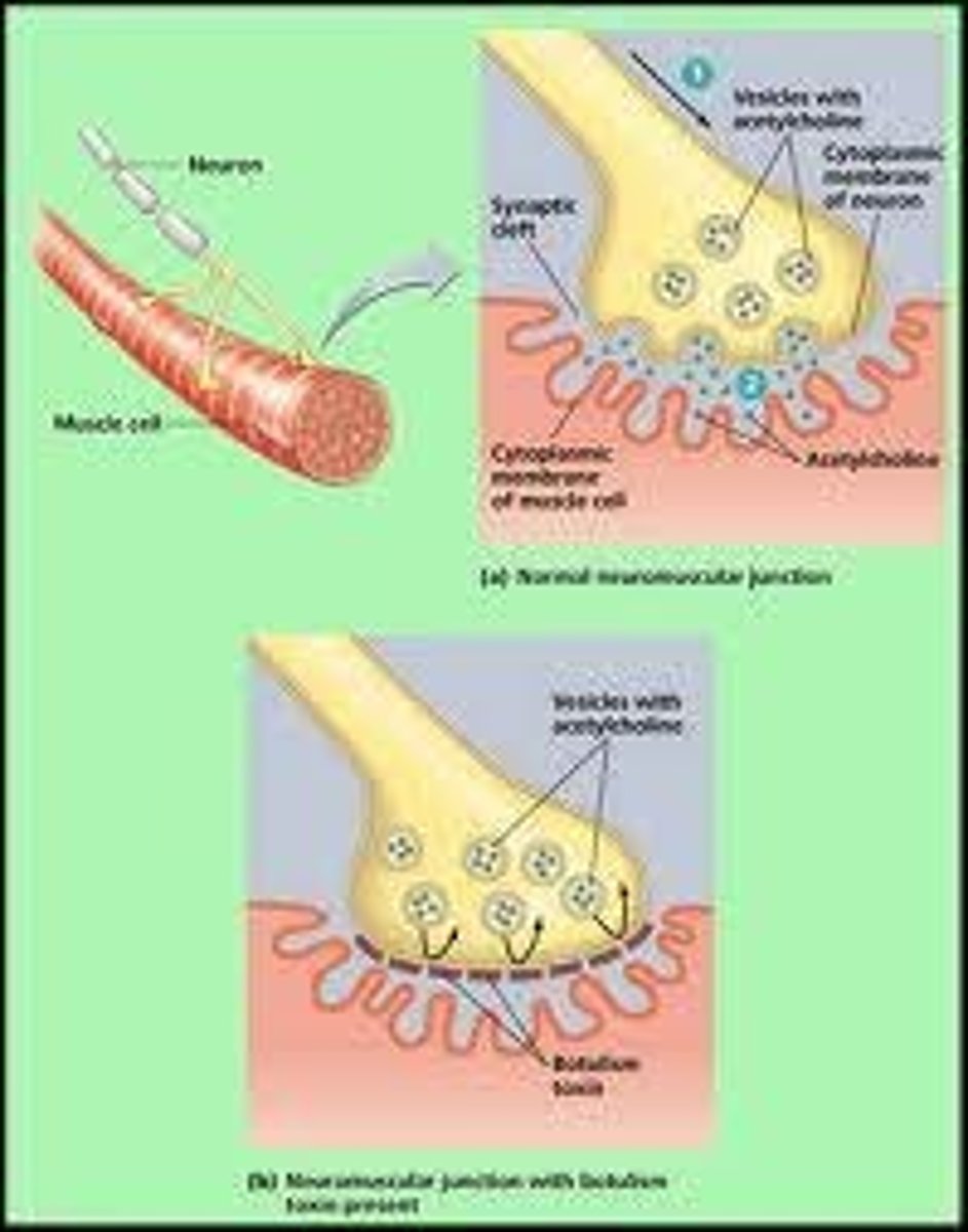 <p>Botulinum toxin inhibits the release of acetylcholine from presynaptic terminals at the skeletal neuromuscular junction, leading to temporary paralysis of the muscle fiber.</p>