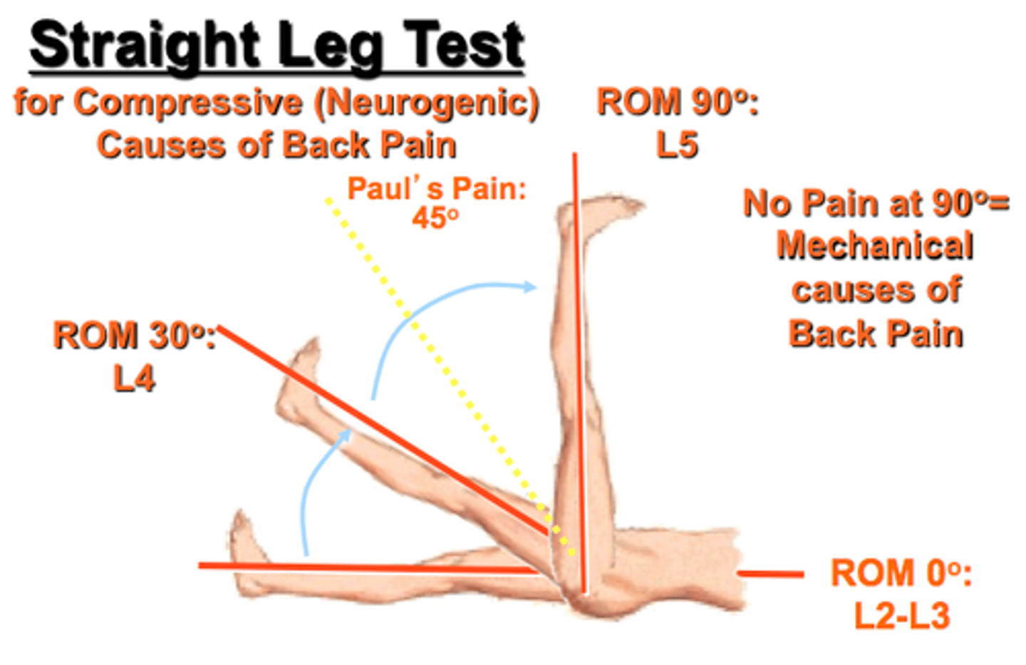 <p>•Puts tension on L5 or S1 nerve root</p><p>•May be done sitting or supine</p><p>•Positive with pain and paresthesia down the leg&nbsp;at 30-70 degrees hip flexion</p><p>•Most important test for identifying who is a good candidate for surgery</p>