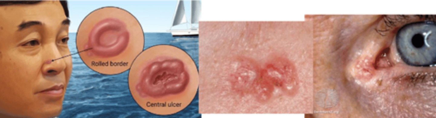 <p>initial = nodular form = round/oval firm bump that has pearly/waxy raised borders with telangiectasia = progression to central ulcerated and excavated core = noduloulcerative form = rodent ulcer core</p>