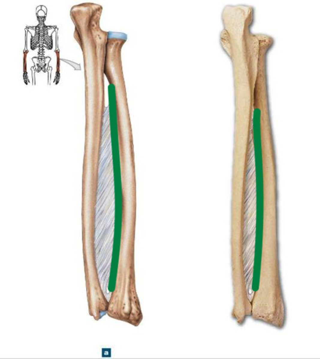 <p>sharp, medial attachment site for the interosseous membrane</p>