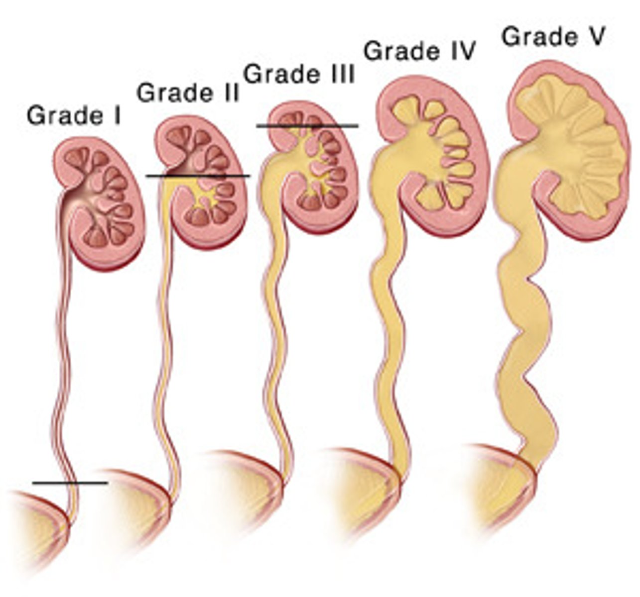 <p>backflow of urine</p><p>- urine moves up ureters toward kidney instead of down into the bladder</p>