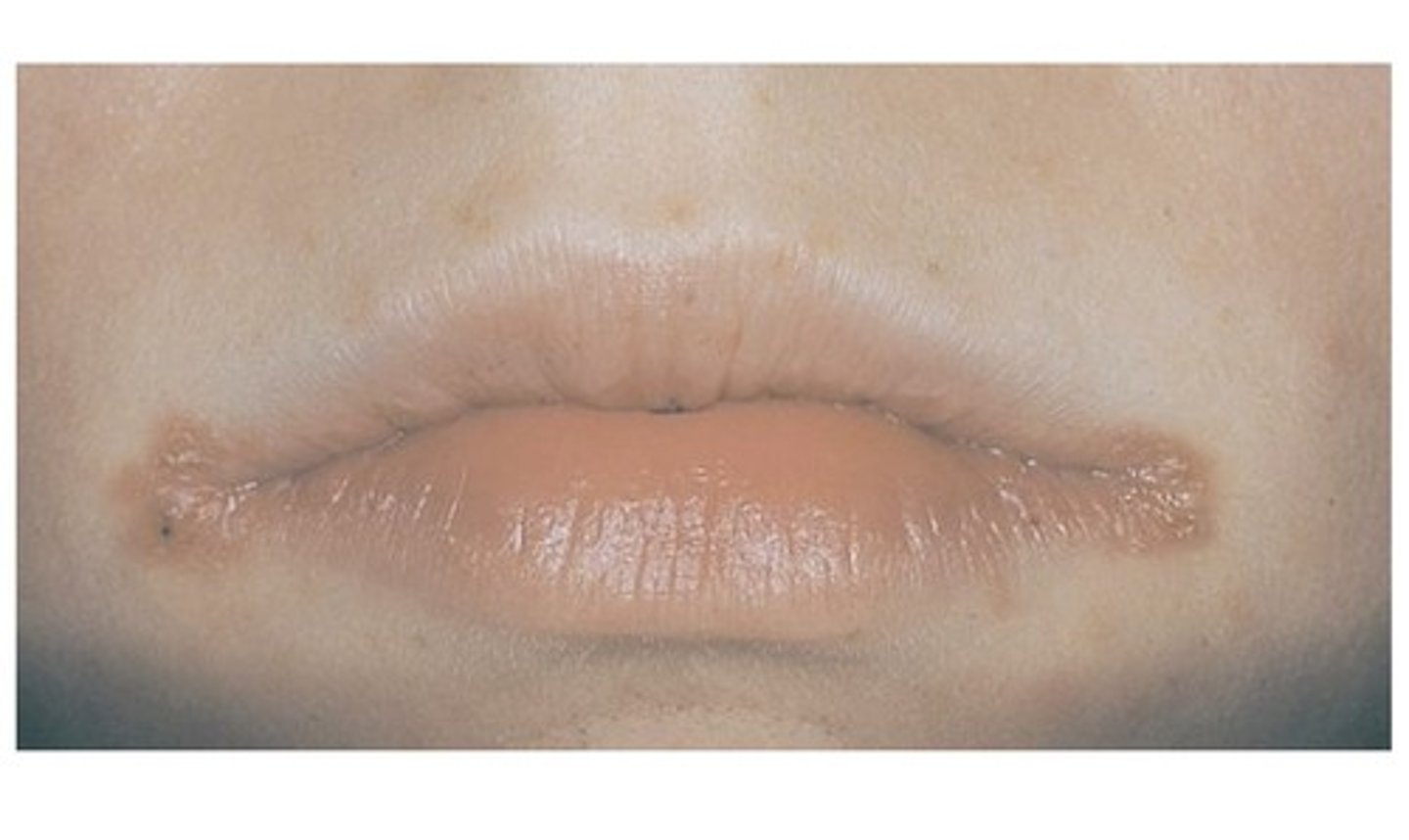 <p>Caused by moistness from drooling, deficiency of vitamin B2 (riboflavin), infection from Candida albicans. Common in elderly clients.</p>