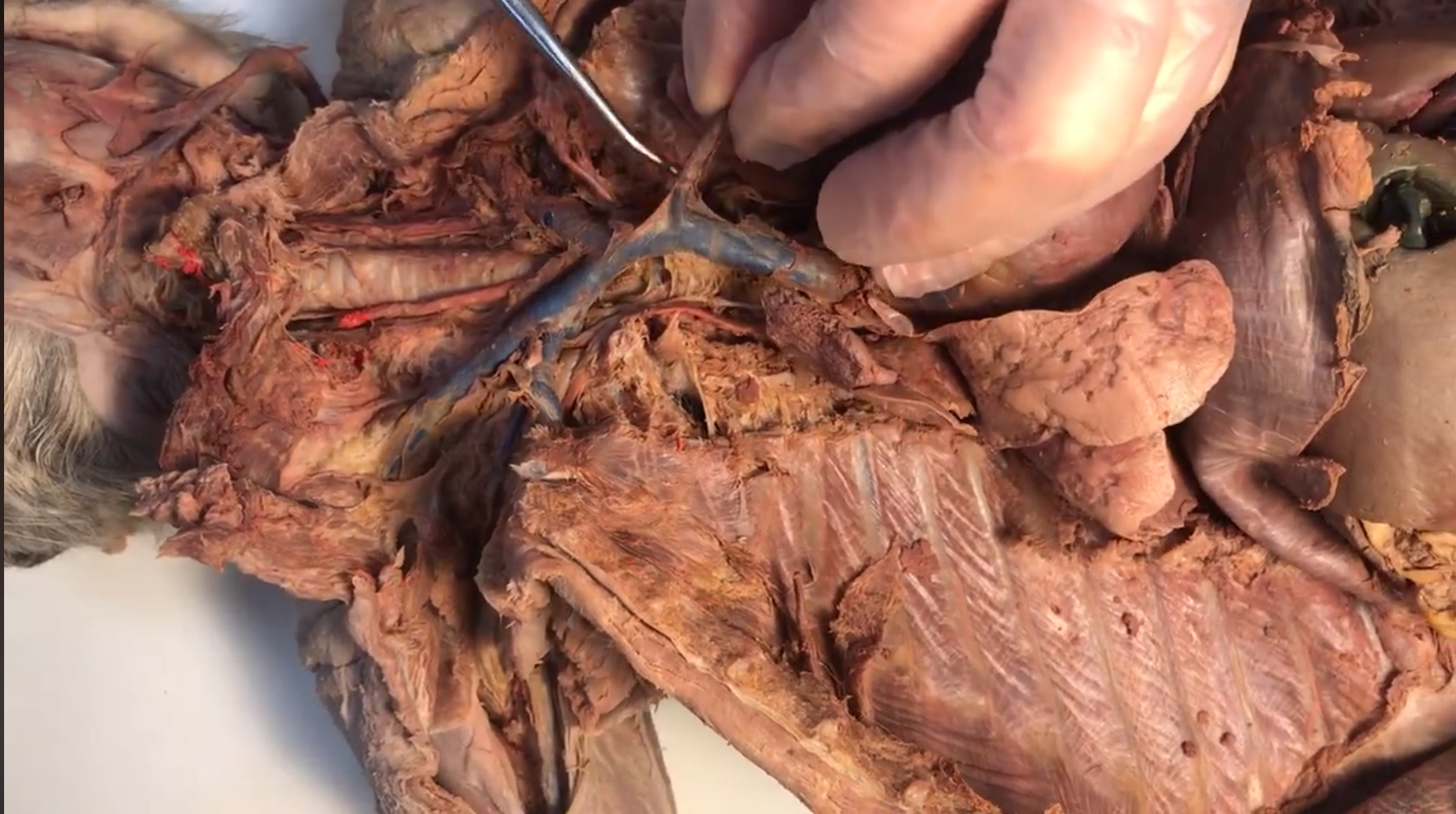 <p>What vein is this</p>