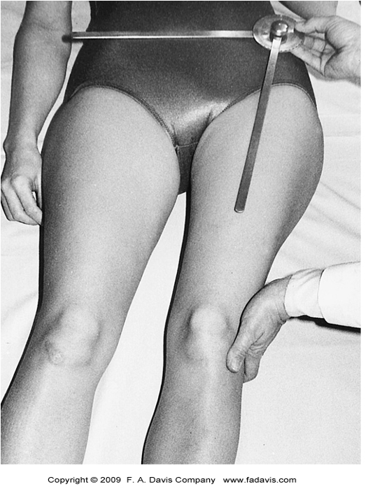 <p><span>•20 dg is normal range</span></p><p><span>•Both knees are extended</span></p><p><span>•Contralateral hip is adducted</span></p><p><span>•Stabilize the pelvis to prevent lateral titling</span></p>
