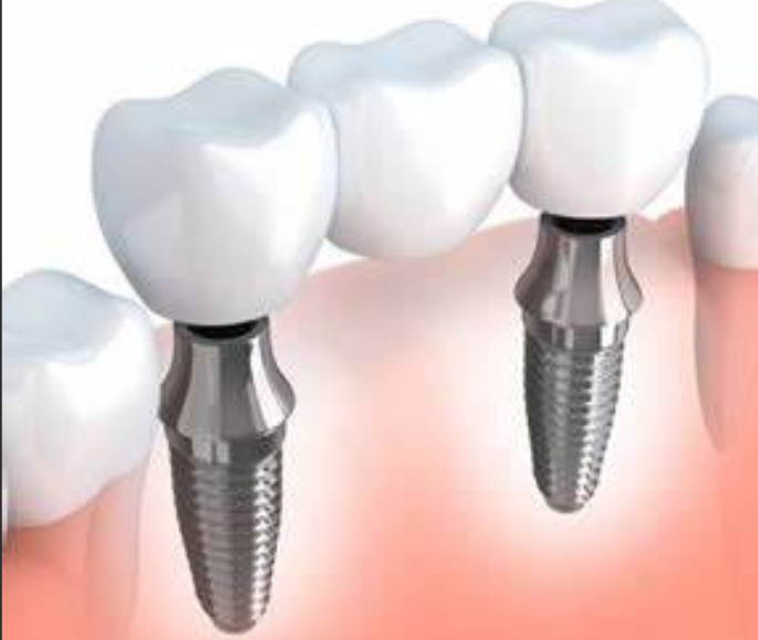 <ul><li><p>they are titanium posts surgically placed into jawbone. Used to dupport dental prosthesis, ranging from single crowns to full dentures, once the implant integrates with the bone (osseointegration) </p></li></ul><p></p>