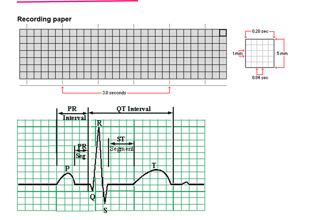 <p><strong>P wave represents</strong> – <strong>Atrial depolarization</strong></p><p><strong>QRS Complex represents</strong> – <strong>Ventricular depolarization</strong> (atrial repolarization also occurs here but is hidden)</p><p><strong>T wave represents</strong> – <strong>Ventricular repolarization</strong></p><p><strong>PR interval normal</strong> – <strong>0.12 – 0.20 sec</strong> (3–5 small boxes)</p><p><strong>Normal heart rates</strong> – <strong>60–100 beats per minute (bpm)</strong></p><p><strong>Sinus Tachycardia</strong> – <strong>&gt;100 bpm</strong></p><p><strong>Sinus Bradycardia</strong> – <strong>&lt;60 bpm</strong></p><p><strong>Calculating heart rates formula:</strong></p><p>Heart rate=300/ # of big boxes between 2 consecutive QRS’s​</p><p><span data-name="check_mark_button" data-type="emoji">✅</span> Example: If there are 4 big boxes → HR = 300 ÷ 4 = 75 bpm</p>