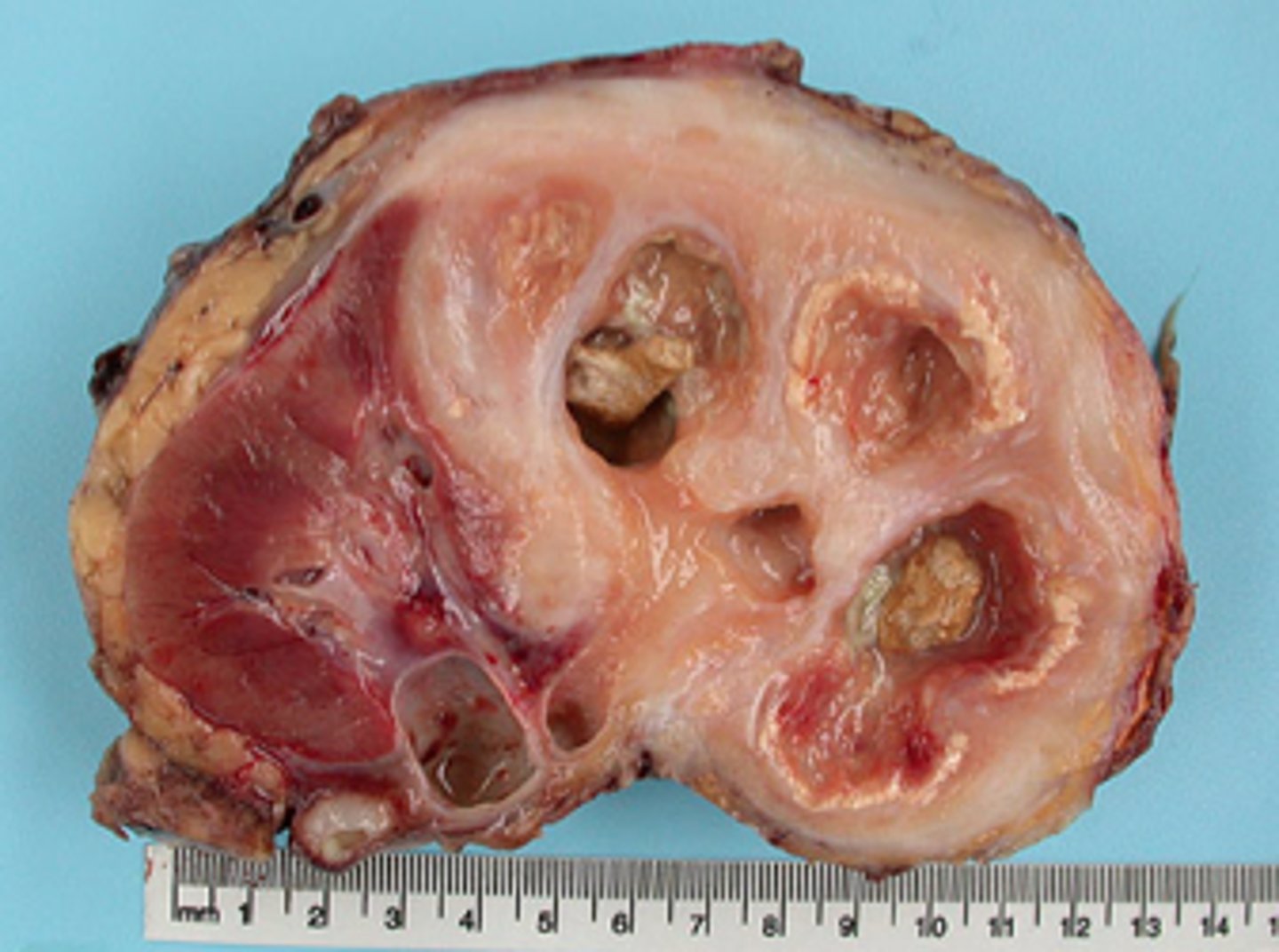 <p>A rare, serious, chronic inflammatory disorder of the kidney characterized by a destructive mass that invades the renal parenchyma</p>