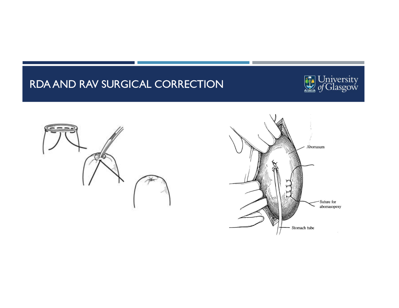 <ul><li><p>follow grater omentum to abomasum, RDA is deflated and corrected as with LDA</p></li><li><p>place purse string suture in abomasum</p></li><li><p>stab incision into center of suture and instert tube</p><ul><li><p>syphon fluid out</p></li></ul></li><li><p>remove tube and pull purse string closed</p></li><li><p>correct volvulus</p></li><li><p>standard omentopexy</p></li></ul><p></p><p></p>