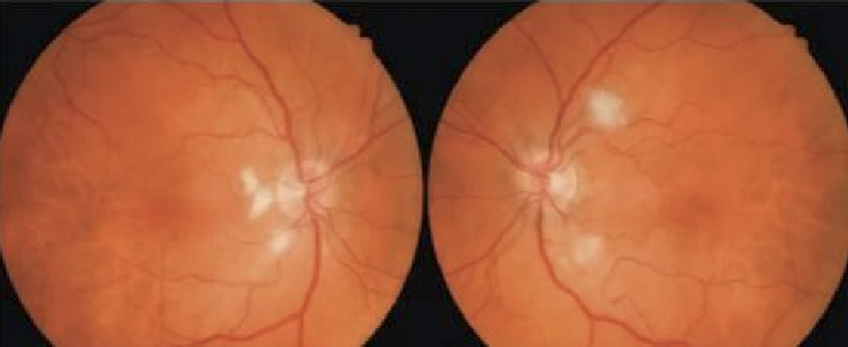 <ul><li><p>Hepatitis C</p></li><li><p>Forms cotton wool spots and flame-shaped hemes in post pole </p></li><li><p>Rarely of visual significance </p></li><li><p>Will resolve after treatment is completed </p></li></ul><p></p>