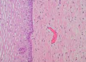 <p>Which one: <strong>Basal Cell Carcinoma</strong> OR <strong>Normal Epithelium</strong></p>