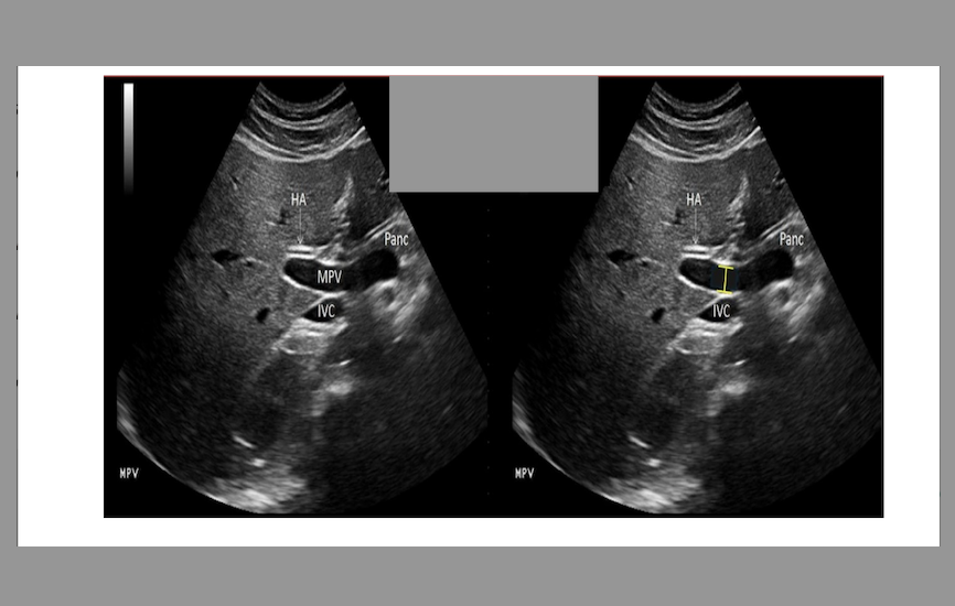 <p>what is the proper caliper placement for assessing portal vein diameter</p><p>.</p><p>a) inner to inner wall at the junction of splenic vein + portal vein</p><p>b) outer to outer wall at the junction of splenic vein + portal vein</p><p>c) outer to outer wall where portal vein crosses IVC</p><p>d) inner to inner wall where portal vein crosses IVC</p>