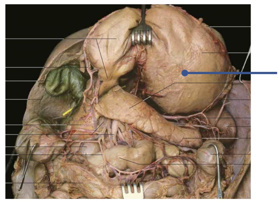 <p><span>An ulceration and associated perforation at the indicated site would permit gut contents to accumulate within what space?&nbsp;</span></p>