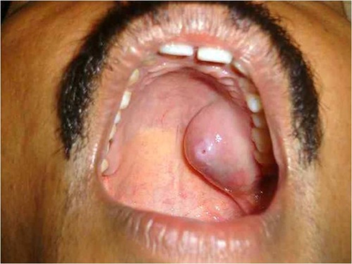 <p>MOST COMMON BENIGN SALIVARY GLAND TUMOR</p><p>• AKA: benign mixed tumor</p><p>• painless, firm swelling</p><p>• moveable (not if on palate)</p><p>• common locations: palate, upper lip, buccal mucosa</p><p>• population: adults 30-50</p>