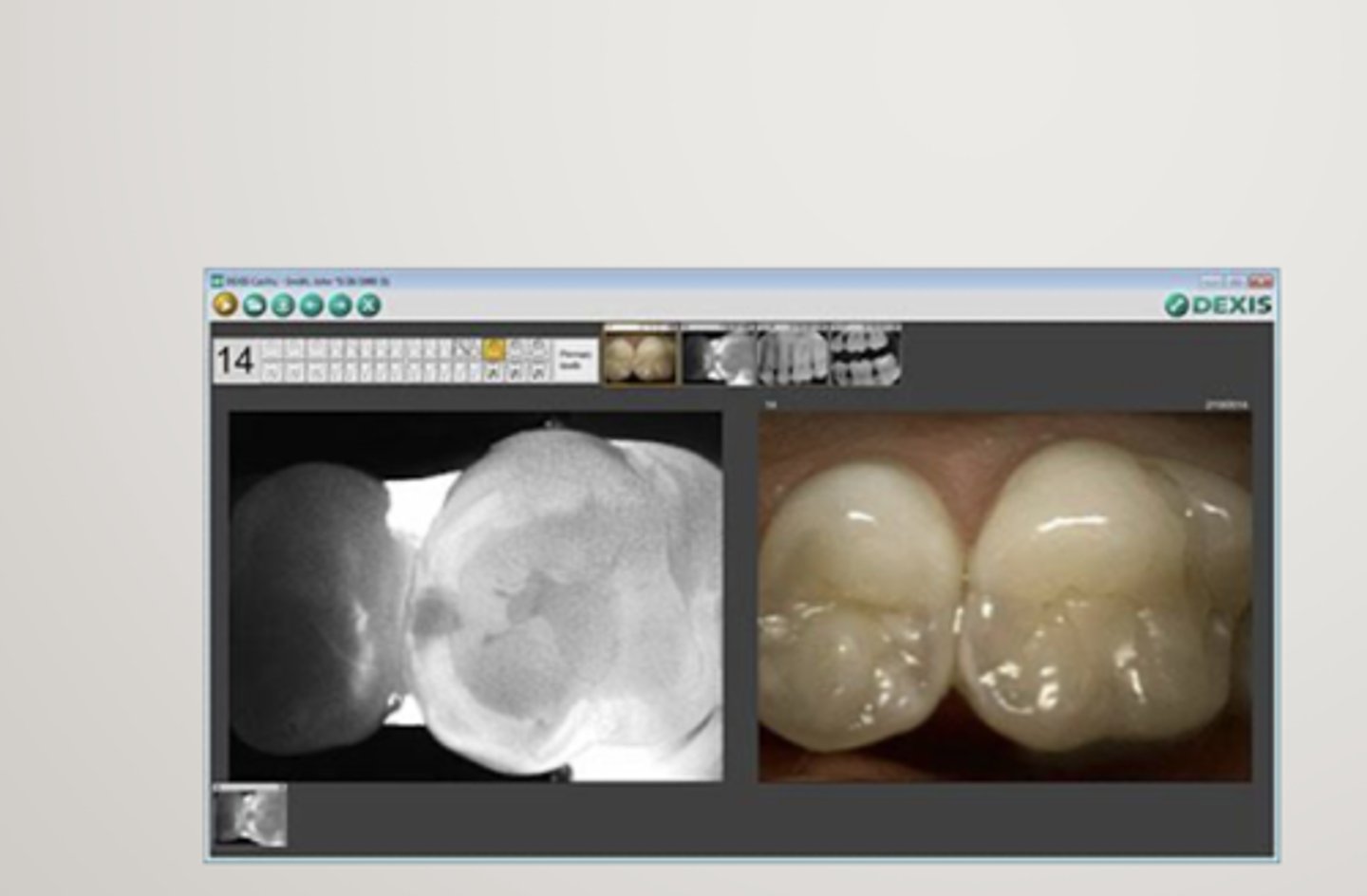 <p>transillumination</p><p>for occlusal, interproximal and recurrent carious lesions and cracks</p><p>near-infrared light</p><p>-enamel appears transparent, porous lesions traps and absorb light, similar to radiographic images</p>