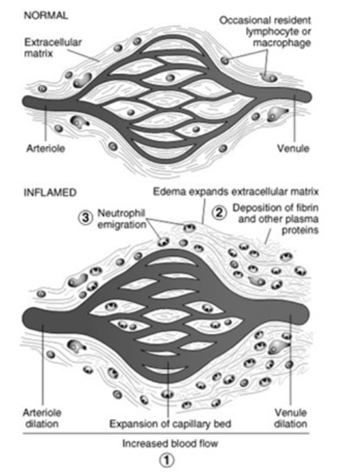 <p>Changes in Vascular Flow and Caliber</p><ul><li><p>Changes<br></p><ul><li><p>Transient <span><strong>[vasoconstriction or vasodilation]</strong></span> (lasting seconds)</p></li><li><p><span><strong>[vasoconstriction or vasodilation]</strong></span></p></li><li><p><span>Increased</span> vascular permeability</p></li><li><p>Results in edema (can be a palpable mass aka tumor)</p></li><li><p>Slowing of circulation</p></li><li><p>Leukocyte margination&nbsp;</p></li></ul></li></ul><p></p>