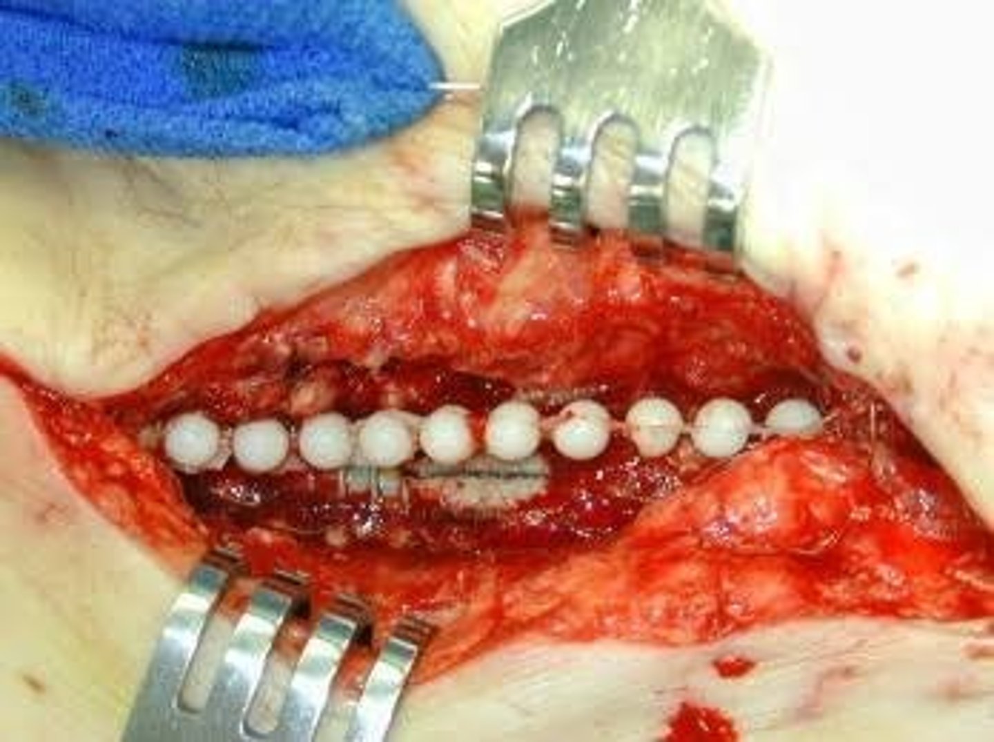 <p>For osteomyelitis and plating of fixators</p>