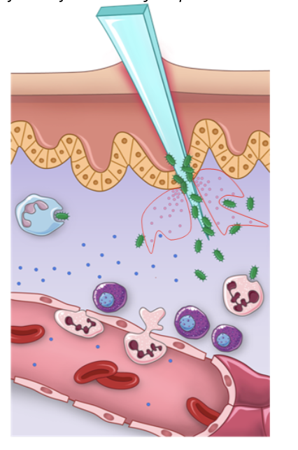 <ul><li><p>vasodilation, an increase in the diameter of blood vessels and permeabilization of the capillaries near the affected area is the first major step in inflammation</p></li><li><p>these changes are induced by vasoactive and chemotactic factors secreted by damaged tissues and activated immune cels ie. macrophages and mast cells</p></li><li><p>the redness and heat are a consequence of the vasodilation inducing a higher blood volume around the infected area</p></li></ul><p></p>