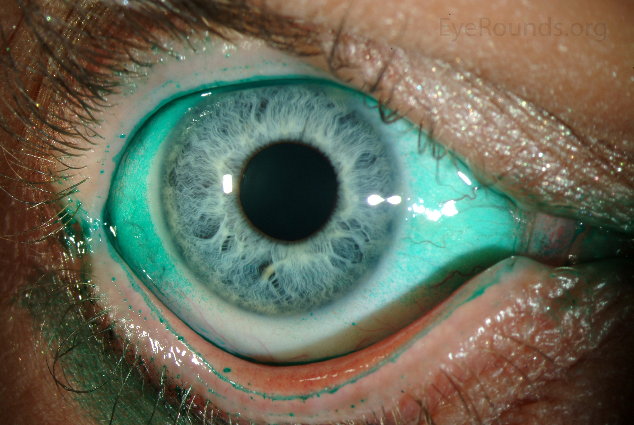 <ul><li><p><span>Bulbar conjunctiva stains first&nbsp;</span></p></li><li><p><span>Temporal and inferior cornea stain as disease progresses</span></p></li></ul><p></p>