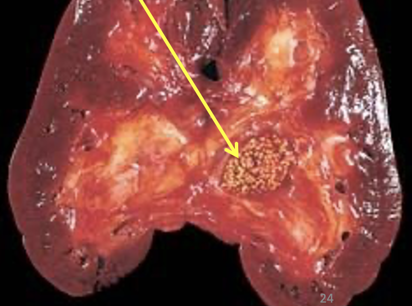 <p>What pathology is shown at the arrow? What is the name of the mechanism causing it?</p>