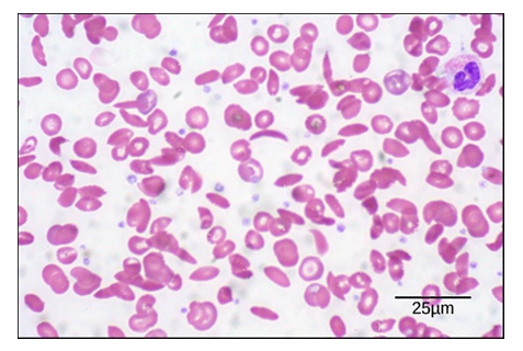 <ul><li><p>Samples can be live or fixed, and stained or unstained&nbsp;</p></li><li><p>Blood smear can be stained with whole cell dye and seen</p><ul><li><p>Distinguishable between biconcave shape of typical RBC (lighter stain in middle)&nbsp;</p></li><li><p>You can see sickled RBC (sickle cell anemia sample)&nbsp;</p></li></ul></li><li><p>Scale bar:</p><ul><li><p>Magnification is 535x</p></li><li><p>Length of scale bar is 25μm</p></li><li><p>Diameter of RBC = about 8μm</p></li></ul></li></ul><p></p>